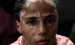 İsrail korkusu küçük kızın hayatını kararttı: 10 yaşındaki Gazzeli Lana vitiligo oldu