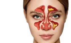 Sinüzit nedir? Tedavisi var mı? Sinüzite ne iyi geli?