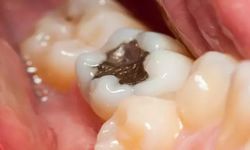 Metal dolgu ve implantı olanlar o işlemden uzak dursun!
