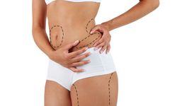Liposuction nedir? Liposuction fiyatları ne kadar?