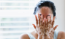 Vitiligo nedir? Vitiligonun sebebi nedir? Vitiligonun hastalığının çaresi var mı? Vitiligo sağlığa zararlı mı?