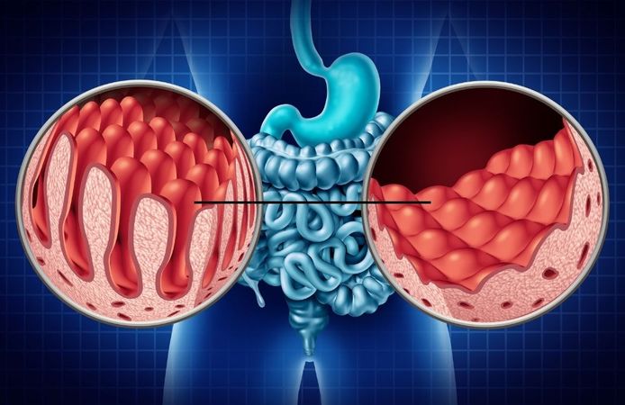 Çölyak hastalığı nedir? Belirtileri, tedavisi ve dikkat edilmesi gerekenler