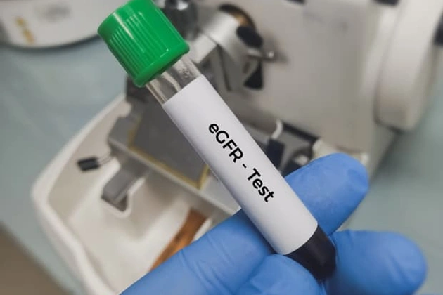 Egfr Testi Nedir Egfr Dusuklugu Ve Yuksekligi Nedir 3458369