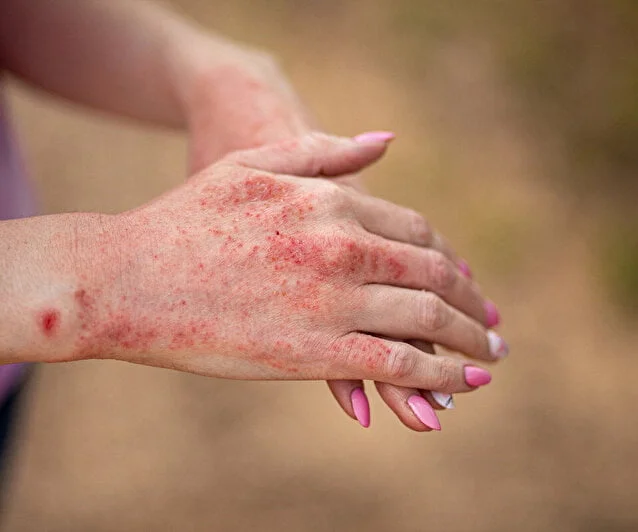 Lupus Hastaligi